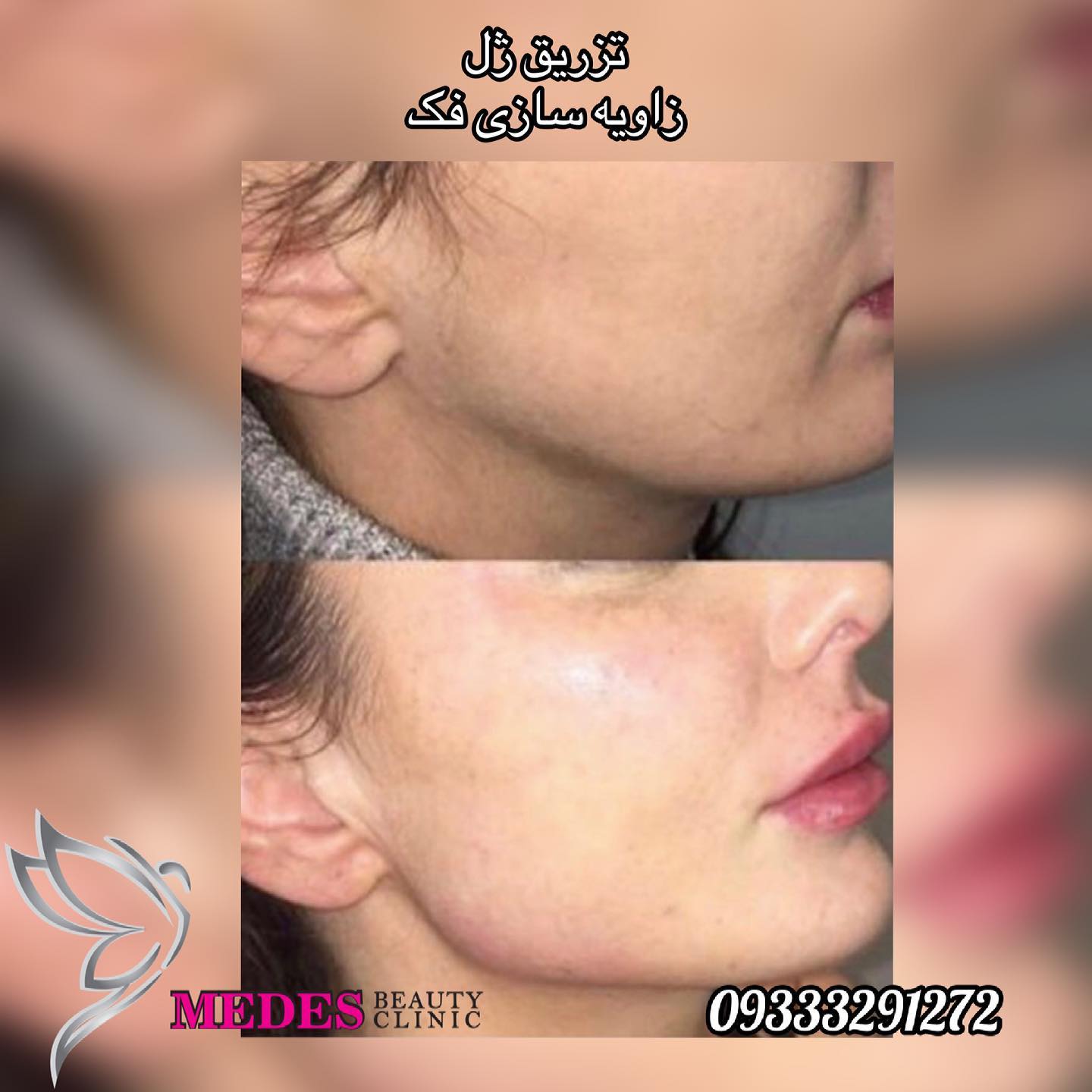 گالری زاویه سازی صورت